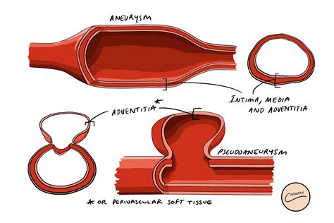 pseudoaneurysm vs aneurysm